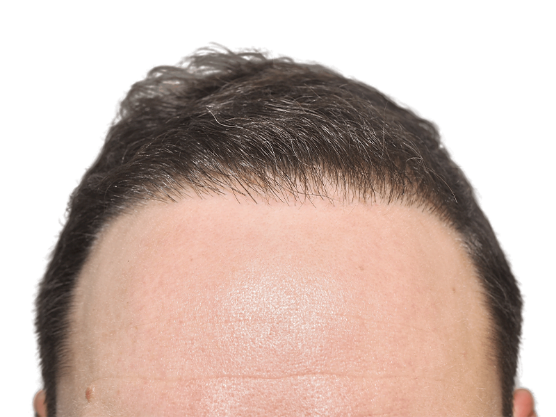 Hair transplant result: Defined hairline on man with dark brown hair. Hair restoration success. Before/after available.