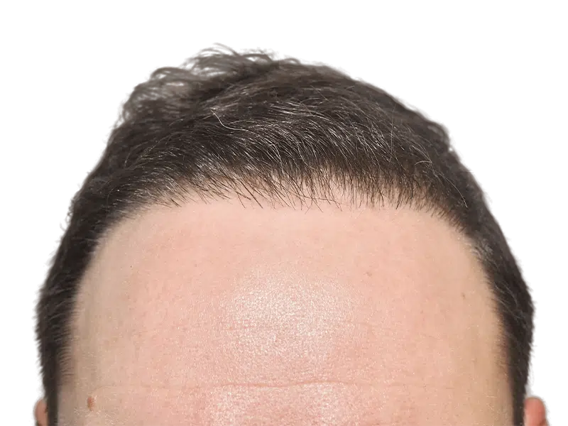 Hair transplant result: Defined hairline on man with dark brown hair. Hair restoration success. Before/after available.