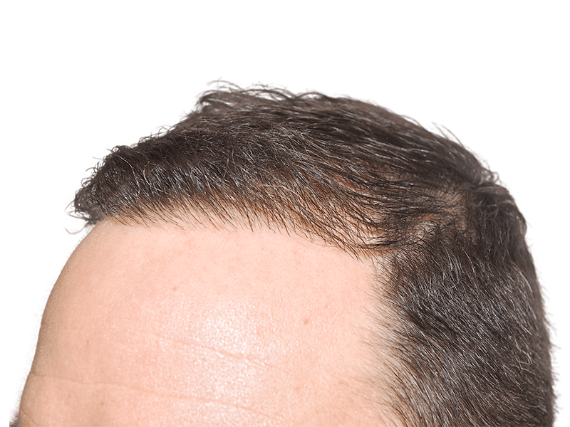 Hair transplant result: Natural, dense hairline achieved. Before & after hair restoration example. Dark brown hair.