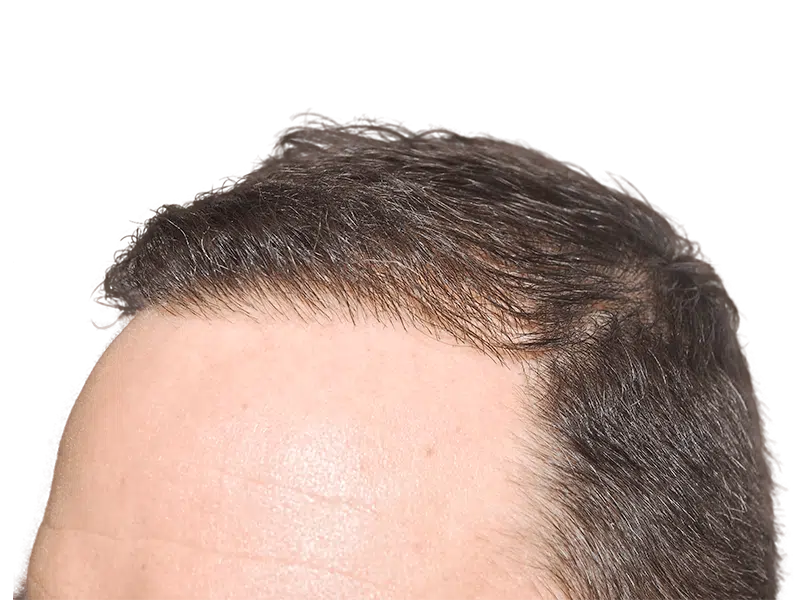 Hair transplant result: Natural, dense hairline achieved. Before & after hair restoration example. Dark brown hair.