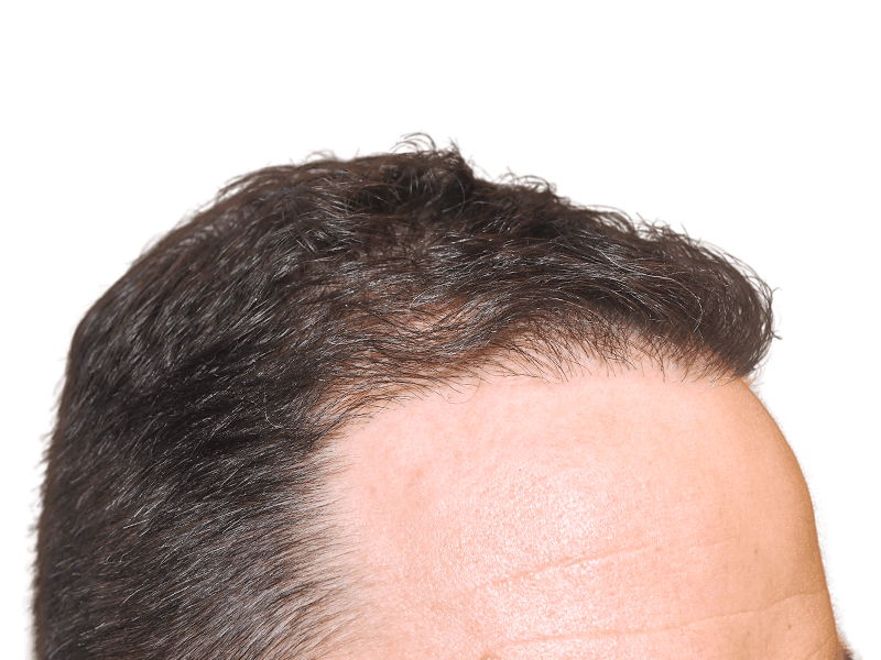 Dense, dark hair growth after hair restoration. Natural hairline achieved with possible hair transplant procedure.
