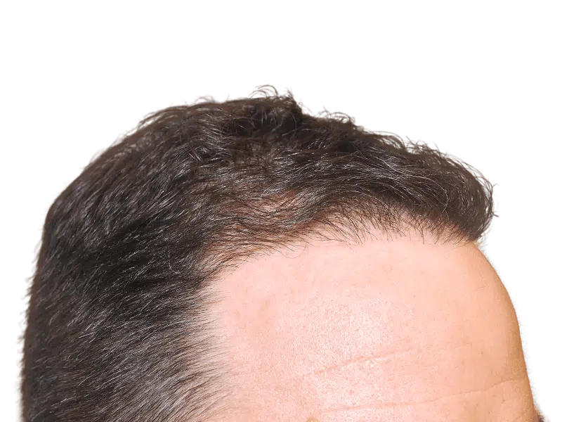 Dense, dark hair growth after hair restoration. Natural hairline achieved with possible hair transplant procedure.