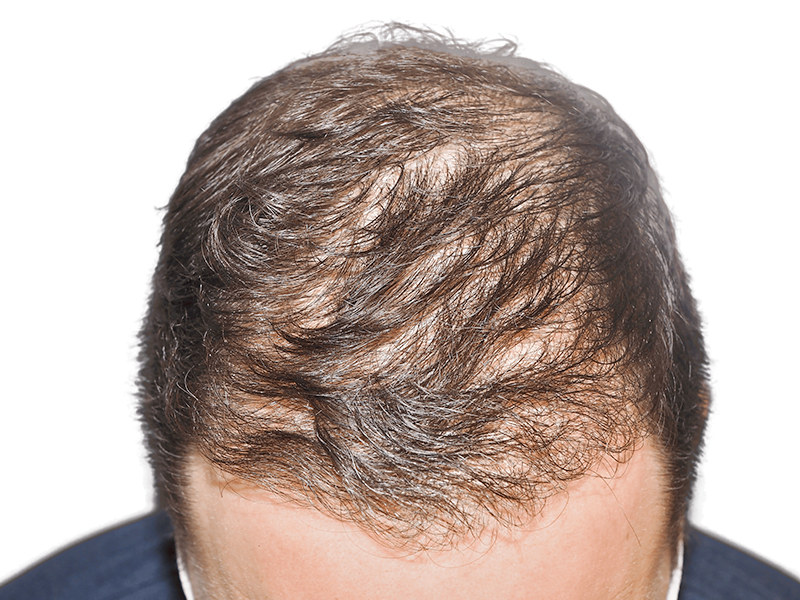 Before hair transplant: Thinning dark brown hair on Caucasian man's scalp. Hair restoration candidate.