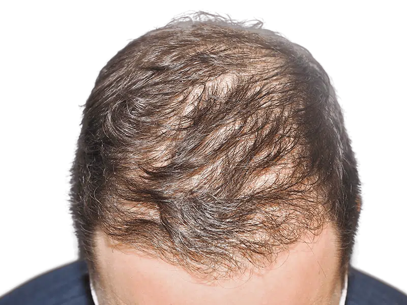 Before hair transplant: Thinning dark brown hair on Caucasian man's scalp. Hair restoration candidate.