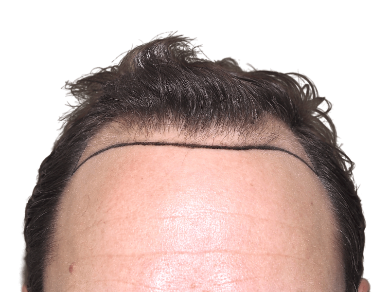 Hair transplant planning: Marked hairline on forehead before hair restoration procedure. Receding hairline visible.