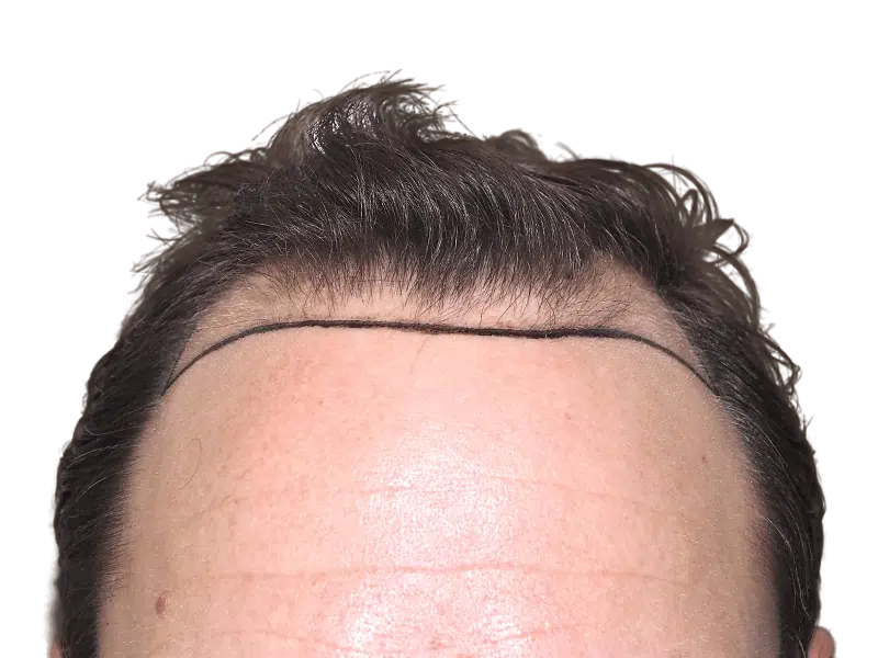 Hair transplant planning: Marked hairline on forehead before hair restoration procedure. Receding hairline visible.