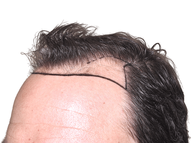 Hair transplant planning: Marked hairline on forehead. Previewing hair restoration results. Before hair transplant procedure.