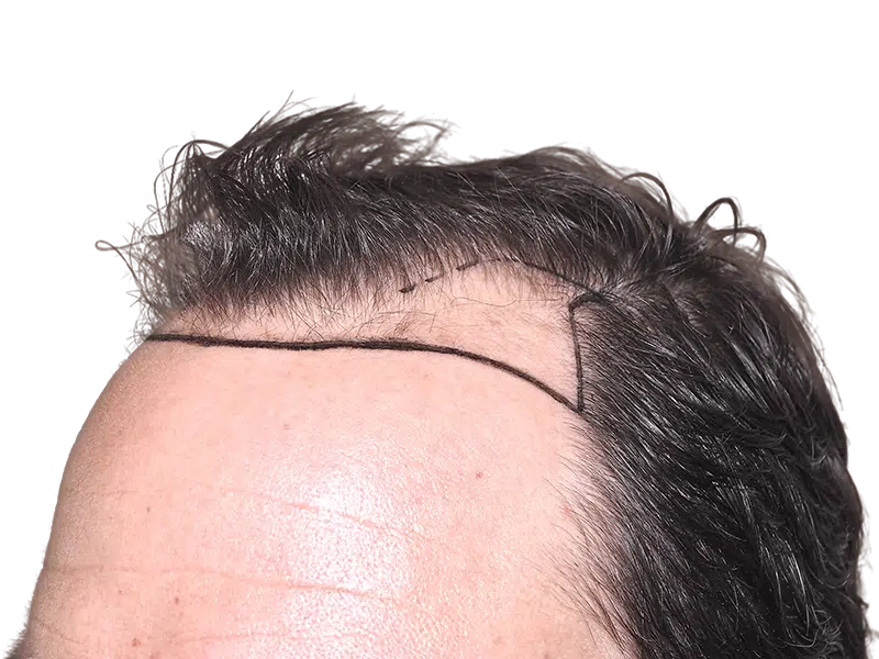 Hair transplant planning: Marked hairline on forehead. Previewing hair restoration results. Before hair transplant procedure.
