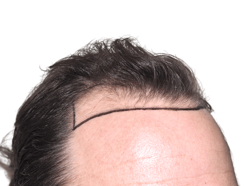 Hair transplant planning: Marked hairline on Caucasian forehead. Dense hair vs. bare skin. Hair restoration procedure.