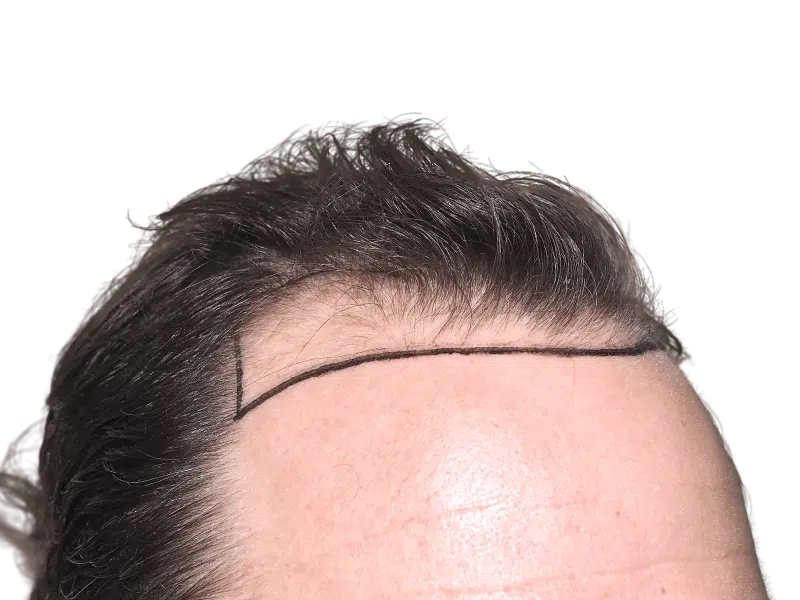 Hair transplant planning: Marked hairline on Caucasian forehead. Dense hair vs. bare skin. Hair restoration procedure.