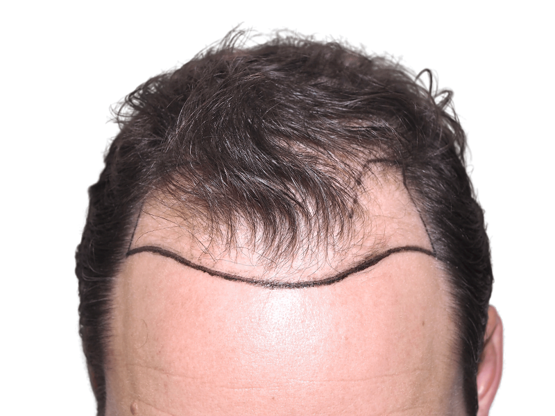 Hair transplant planning: Marked hairline on forehead before hair restoration procedure. Shows proposed hairline design.