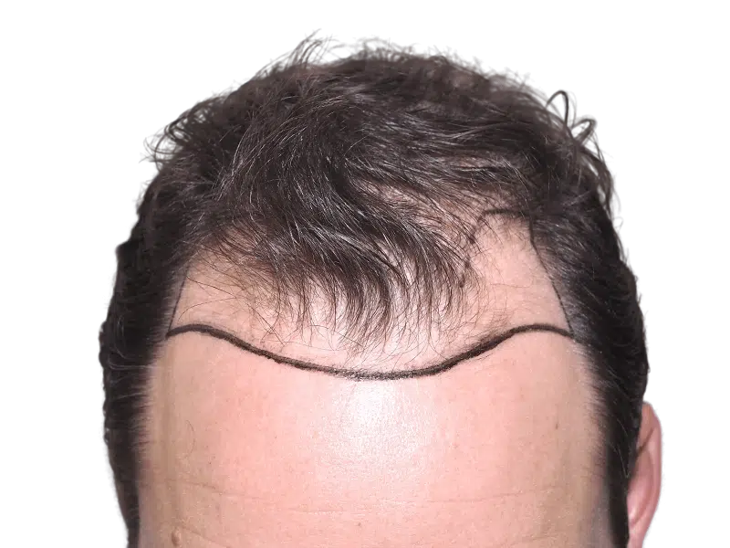 Hair transplant planning: Marked hairline on forehead before hair restoration procedure. Shows proposed hairline design.