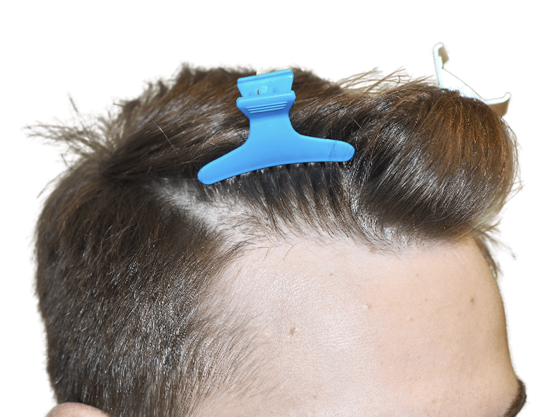 Hair transplant close-up. Man with clips prepping for hair restoration. Brown hair, hairline focus. Potential before/after.
