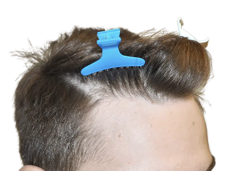 Hair transplant close-up. Man with clips prepping for hair restoration. Brown hair, hairline focus. Potential before/after.