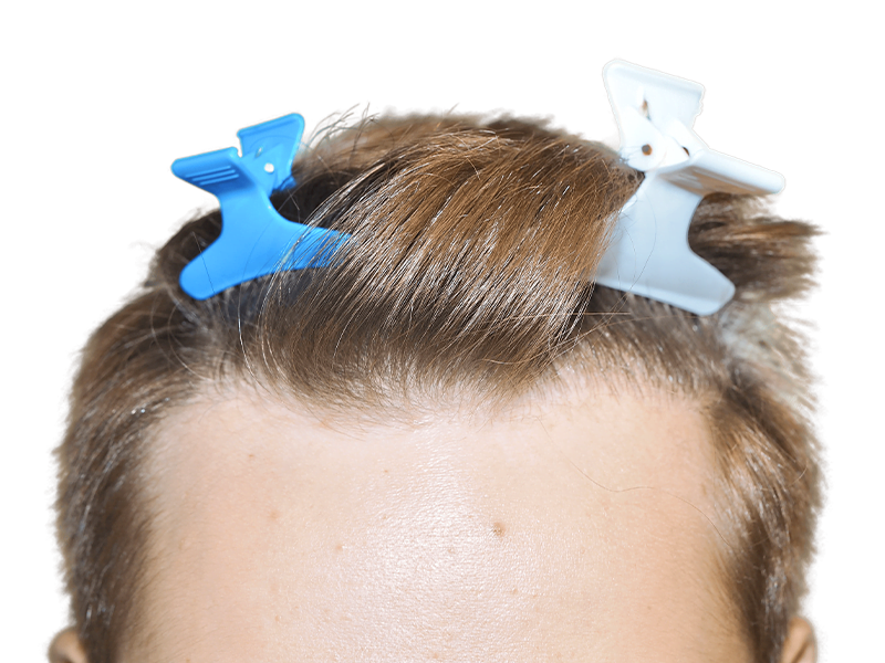 Hair restoration candidate. Healthy hair, neatly styled. Potential hair transplant before image. Blonde/light brown hair.