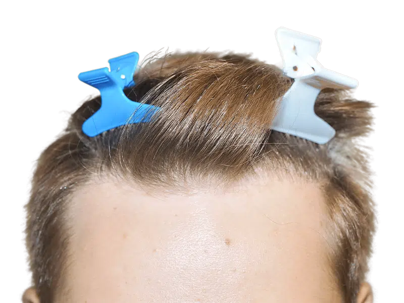 Hair restoration candidate. Healthy hair, neatly styled. Potential hair transplant before image. Blonde/light brown hair.