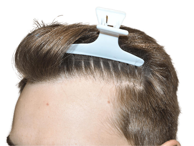 Hairline close-up. Light brown hair, fair skin. Possible hair transplant before/after. Hair restoration example.