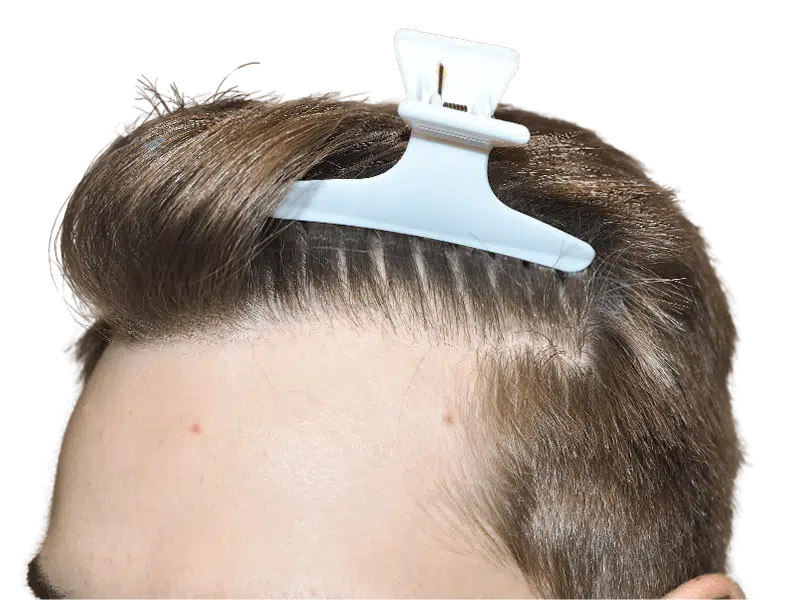 Hairline close-up. Light brown hair, fair skin. Possible hair transplant before/after. Hair restoration example.