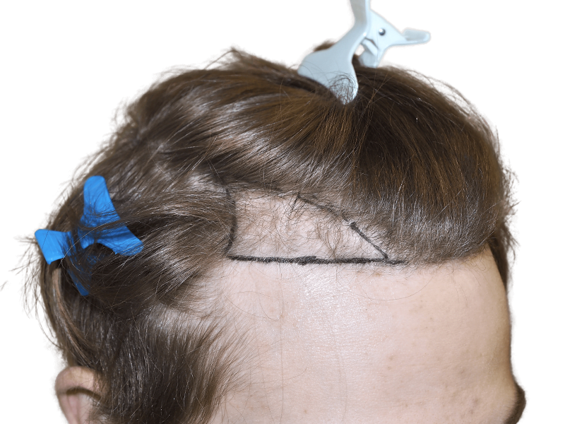 Hair transplant prep: Light brown hair marked for restoration. Before/after potential shown. Hair loss solution.
