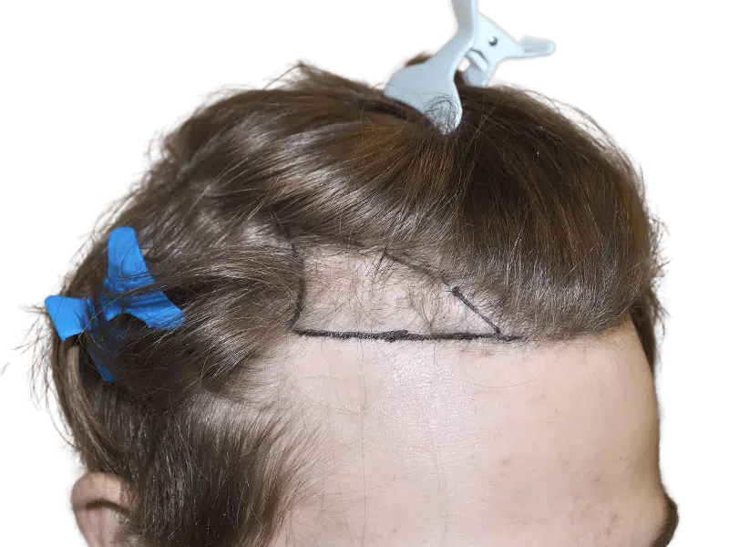 Hair transplant prep: Light brown hair marked for restoration. Before/after potential shown. Hair loss solution.