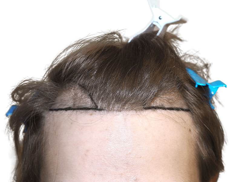 Hair transplant planning: Marked hairline on forehead before hair restoration procedure. Shows potential new hairline design.