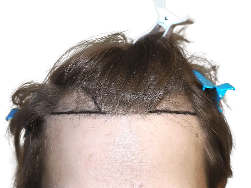 Hair transplant planning: Marked hairline on forehead before hair restoration procedure. Shows potential new hairline design.