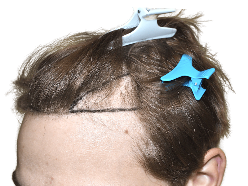 Hair transplant planning: Receding hairline marked for restoration. Before photo showing planned procedure area.