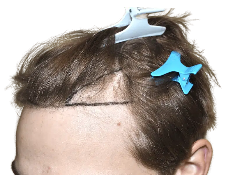 Hair transplant planning: Receding hairline marked for restoration. Before photo showing planned procedure area.