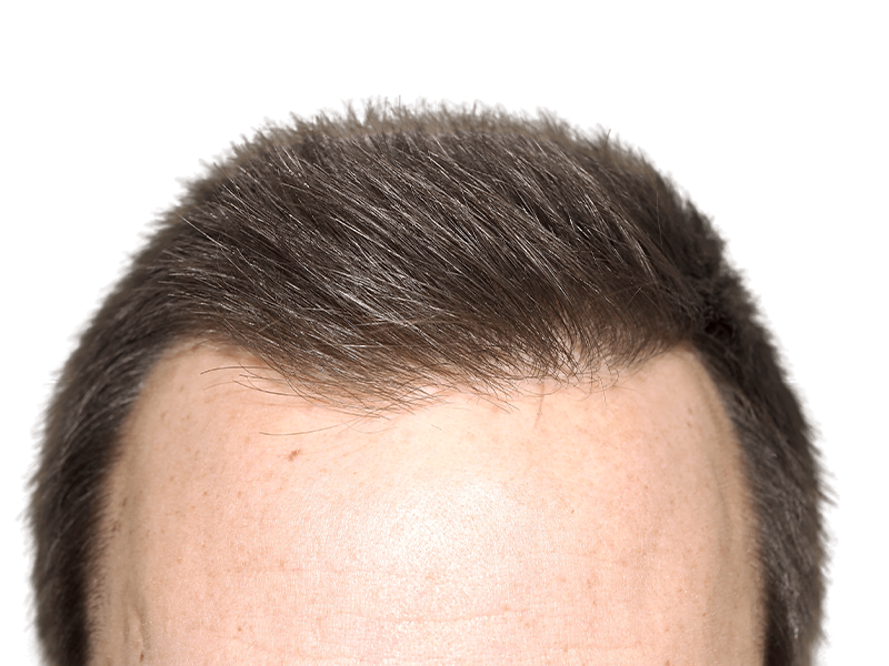 Hair transplant result: Dense, natural hairline achieved. Successful hair restoration procedure. Before/after available.