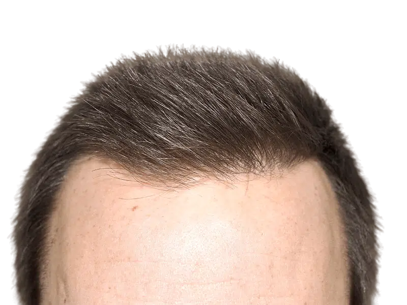Hair transplant result: Dense, natural hairline achieved. Successful hair restoration procedure. Before/after available.