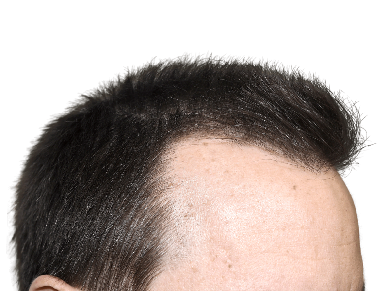 Hair transplant result: Man's forehead showing improved hairline density. Before & after hair restoration procedure.