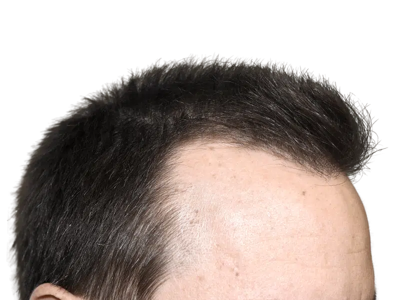 Hair transplant result: Man's forehead showing improved hairline density. Before & after hair restoration procedure.