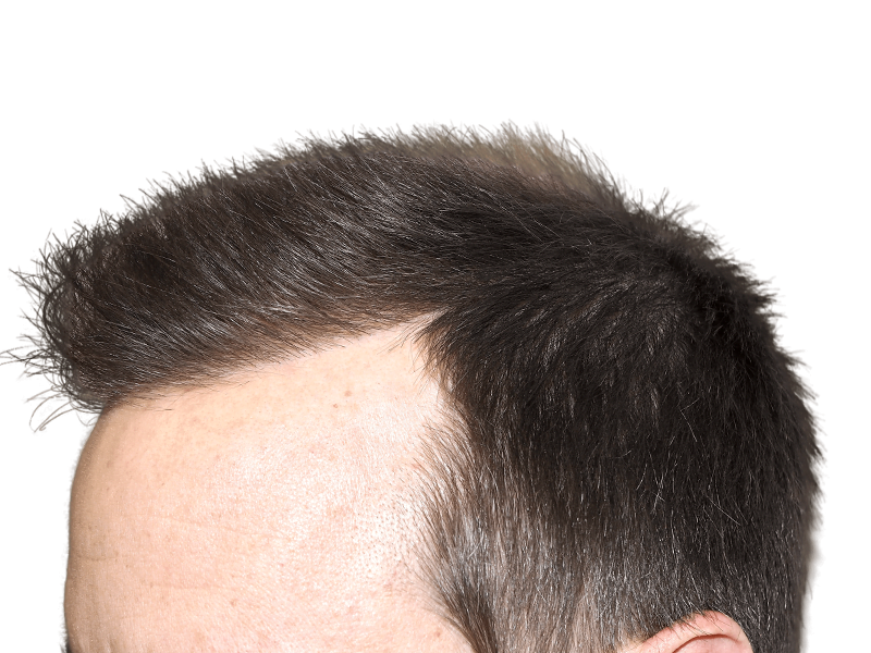 Natural hairline after hair transplant. Dark hair, fair skin. Successful hair restoration results.