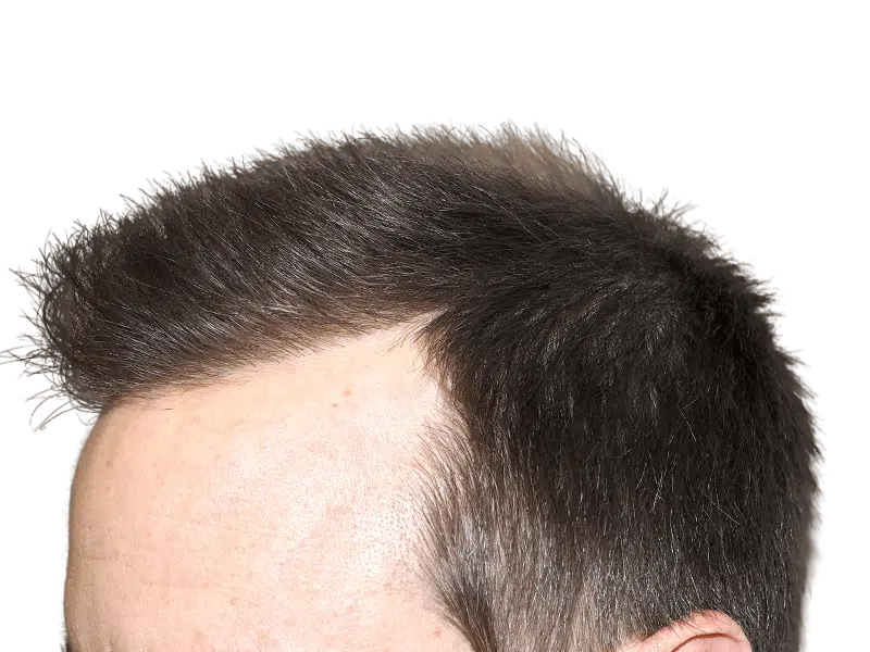 Natural hairline after hair transplant. Dark hair, fair skin. Successful hair restoration results.