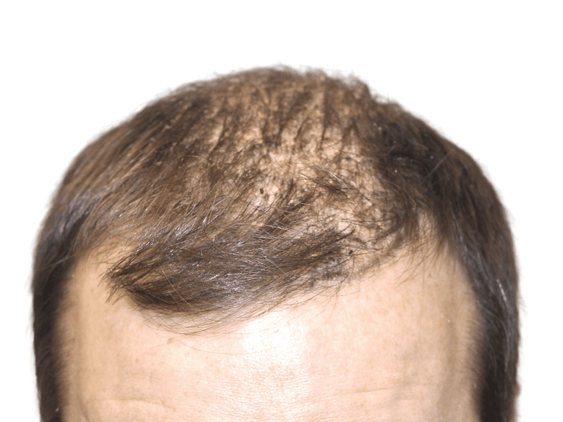 Thinning brown hair on a Caucasian man's head. Possible hair transplant candidate. Hair restoration before image.