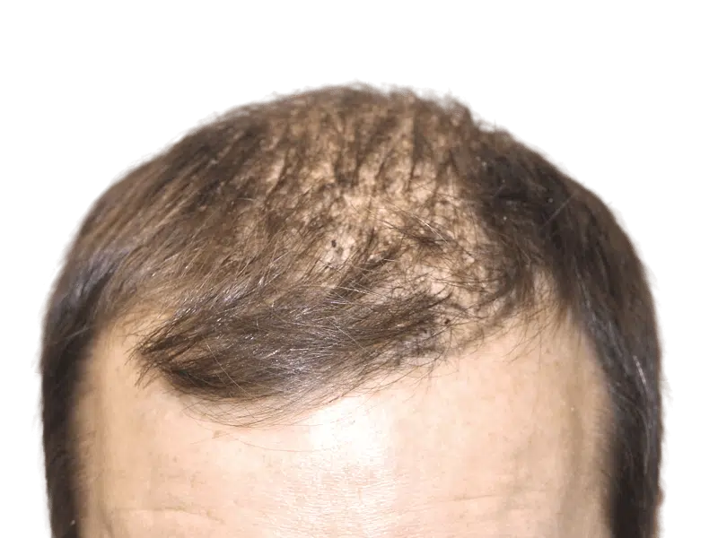 Thinning brown hair on a Caucasian man's head. Possible hair transplant candidate. Hair restoration before image.