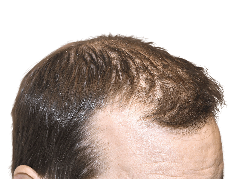 Thinning hair & receding hairline. Considering hair restoration or transplant? See before & after results.