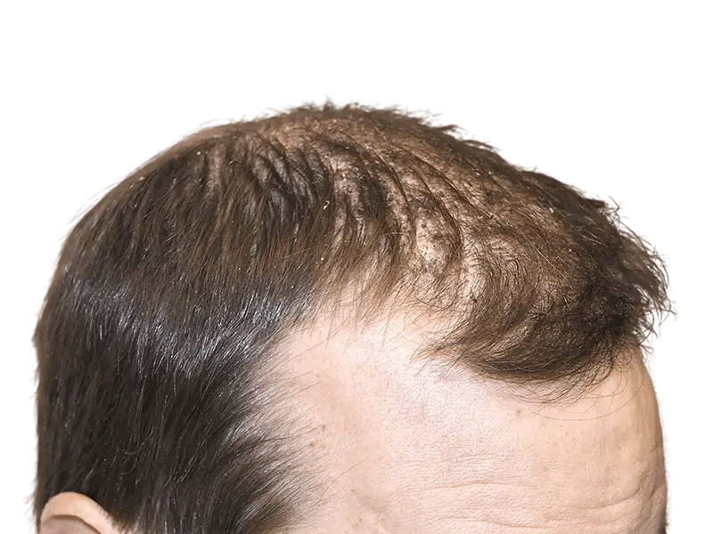 Thinning hair & receding hairline. Considering hair restoration or transplant? See before & after results.