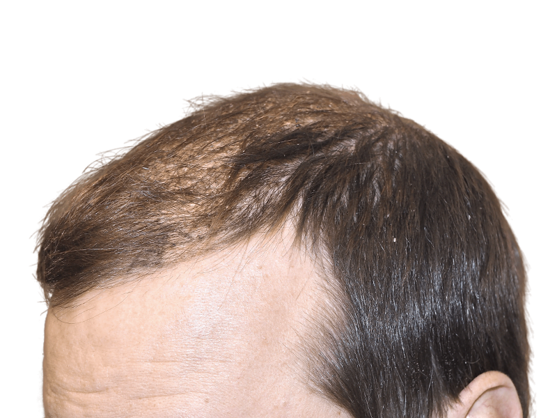Thinning hair at the front hairline. Potential hair loss candidate. Before hair transplant consideration.