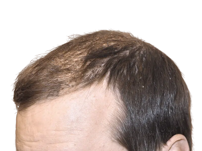 Thinning hair at the front hairline. Potential hair loss candidate. Before hair transplant consideration.