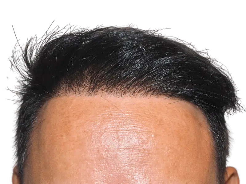 Hair transplant result: Man with dense, natural-looking hairline. Successful hair restoration procedure. Before/after potential.