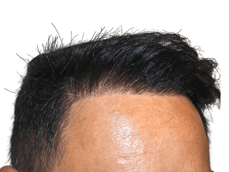 Hair transplant result: Asian man's restored hairline. Dense, dark hair showcases successful hair restoration procedure.