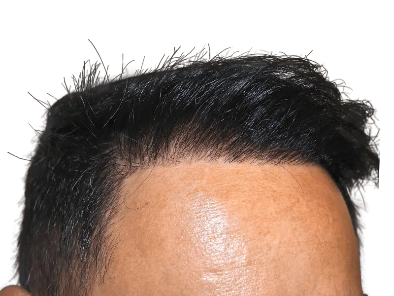 Hair transplant result: Asian man's restored hairline. Dense, dark hair showcases successful hair restoration procedure.