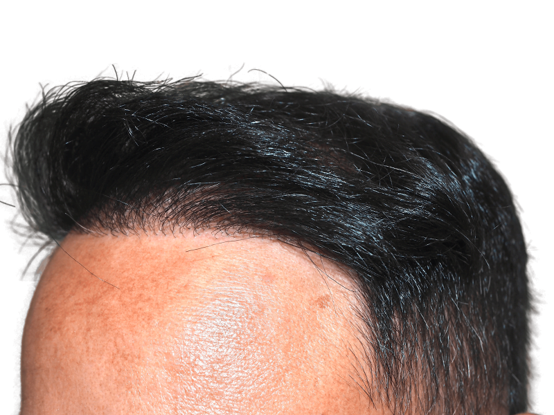 Hair transplant result: Dark hair restored along hairline. Before & after density improvement visible. Mole on forehead.