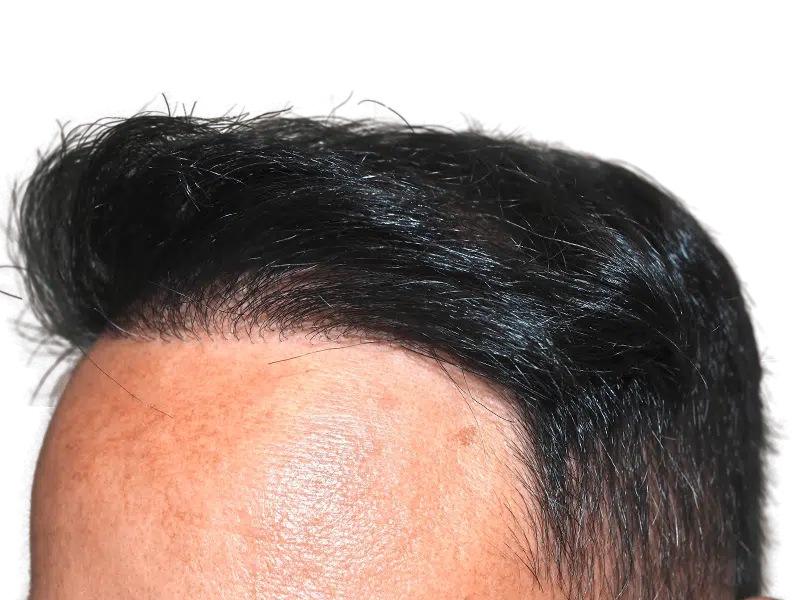 Hair transplant result: Dark hair restored along hairline. Before & after density improvement visible. Mole on forehead.