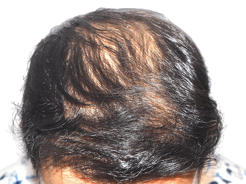 Thinning dark hair on scalp. Potential hair loss candidate. Consider hair restoration or transplant options.