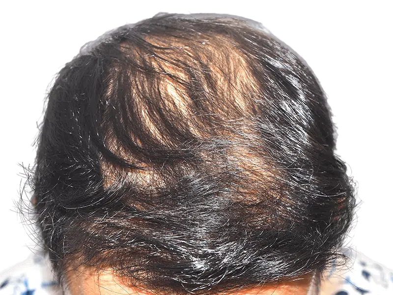 Thinning dark hair on scalp. Potential hair loss candidate. Consider hair restoration or transplant options.
