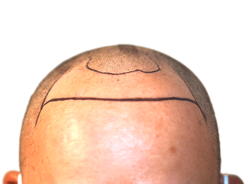 Before hair transplant: Marked scalp showing thinning hair. Hair restoration procedure planning for improved density.