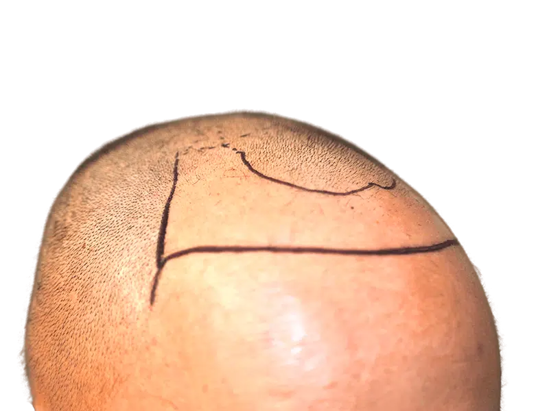 Before hair transplant: Shaved head with sparse hair. Marked scalp for hair restoration procedure.