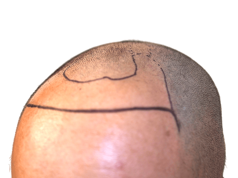 Hair transplant result: Man's shaved head with marked hairline. Hair restoration procedure shown. Before/after example.